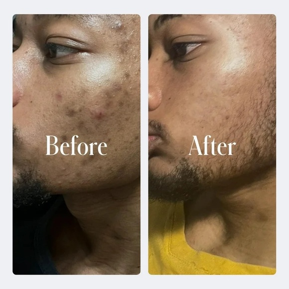 GEOLOGIE Clear System Level 3 Acne Treatment & Skincare Set 3pc, NEW - Picture 4 of 6